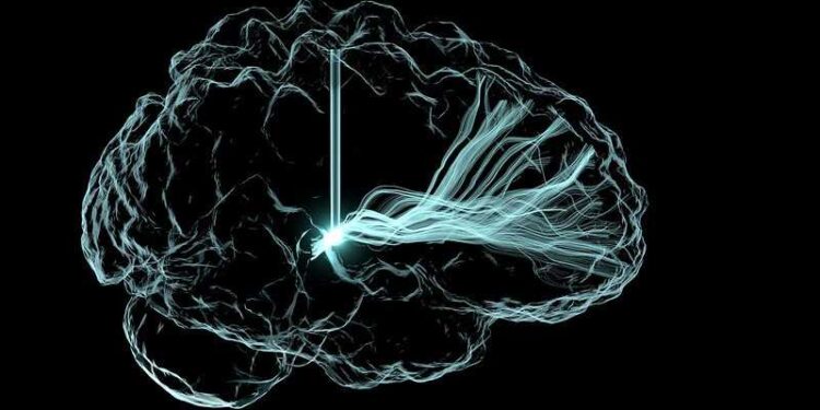 Deep Brain Stimulation Illustration -  
This image is an artistic rendering of deep brain stimulation (DBS), an approach now under clinical investigation to treat cognitive impairment that can arise after a traumatic brain injury and other conditions.
The vertical lines represent wire leads with a single electrode that has been inserted deep within the brain to reach a region involved in cognition, the central thalamus. The leads are connected to a pulse generator, a pacemaker-like device that has been implanted in a patient’s chest (not shown).  The leads’ electrode emits electrical impulses that stimulate a network of neuronal fibers (blue-white streaks) involved in arousal, which is an essential component of human consciousness. The hope is that DBS will improve attention and reduce fatigue in people with serious brain injuries that are not treatable by other means.
This image won first place in the still image category of the BRAIN Initiative’s “Show Us Your Brain Contest!”

Read more: directorsblog.nih.gov/2019/08/01/the-amazing-brain-deep-b...

Credit: Andrew Janson, Butson Lab, University of Utah

NIH support from: National Institute of Neurological Disorders and Stroke
, tags: ki-gesteuertes - National Institutes of Health (NIH) via Flickr